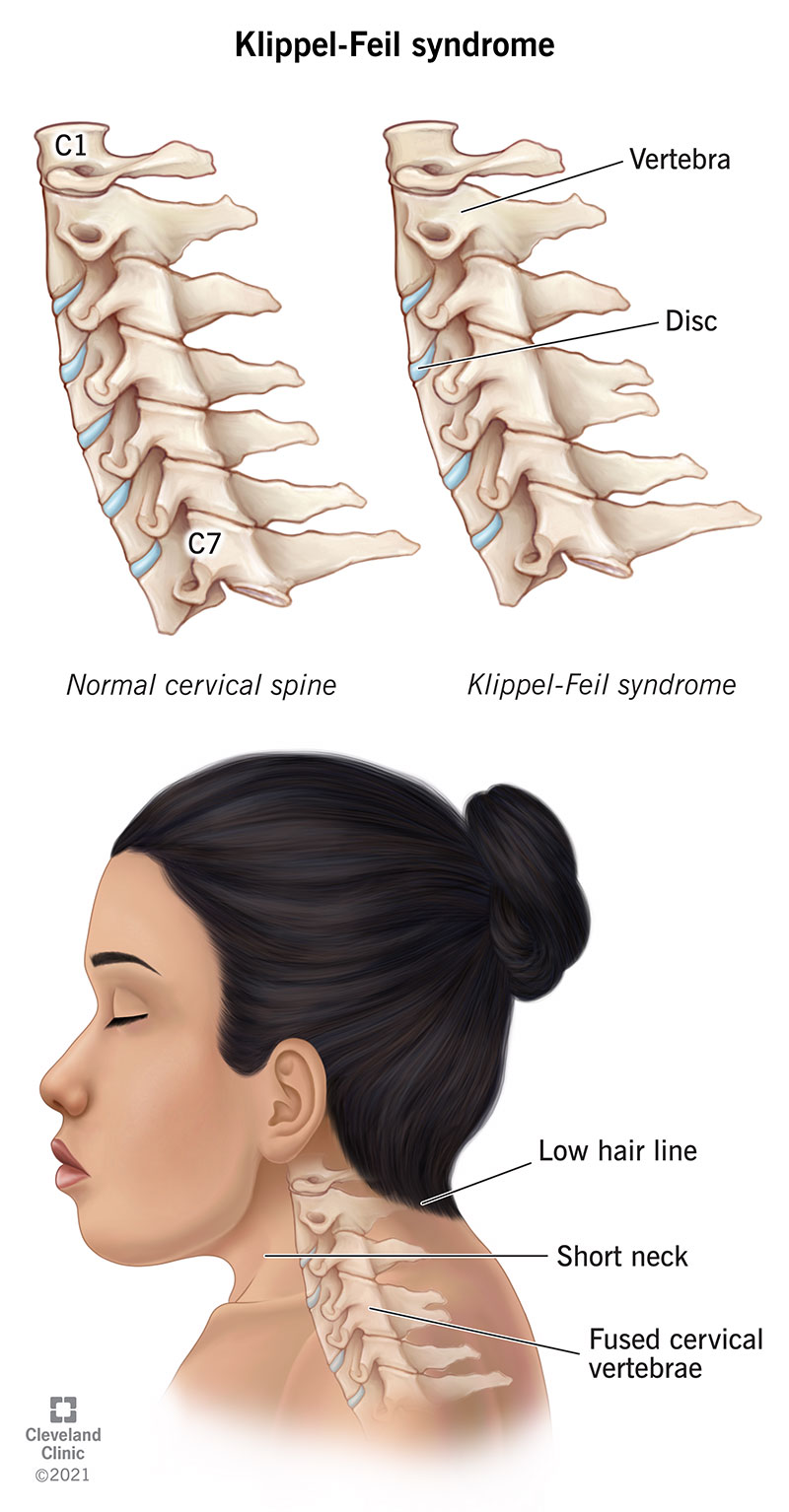 Una donna con la sindrome di Klippel-Feil.